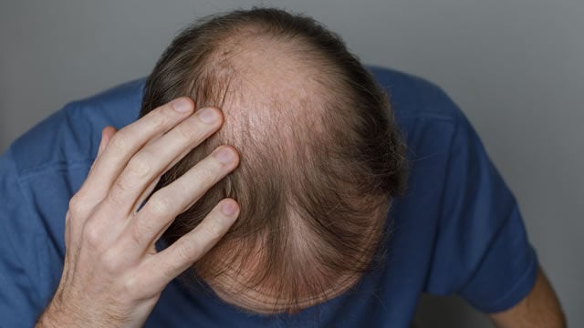 alopecia