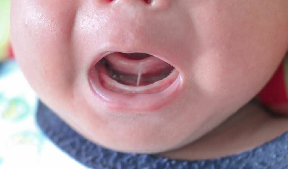 La Sociedad Española de Cirugía Oral y Maxilofacial y de Cabeza y Cuello (SECOMCYC) alerta de un elevado número de cirugías de frenillo lingual innecesarias