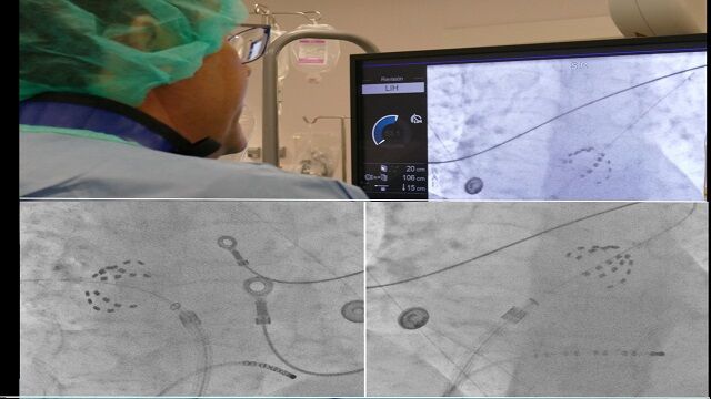 La ablación de venas pulmonares por electroporación permite corregir la fibrilación auricular respetando el resto de tejidos