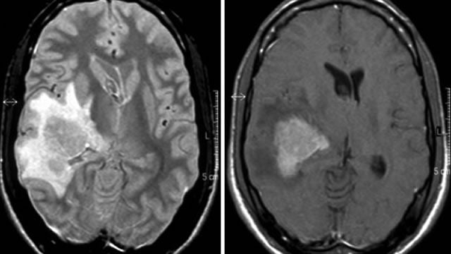 Linfoma cerebral, un tipo de tumor raro, poco frecuente y difícil de diagnosticar de manera temprana